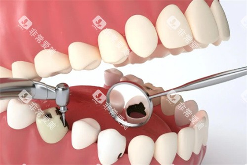 拔龋齿动画展示图