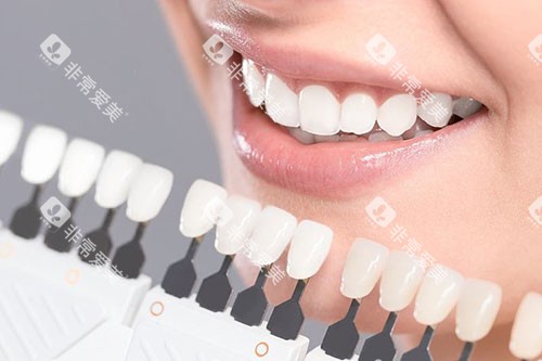 牙齿贴面色卡对比 牙齿贴面色卡对比