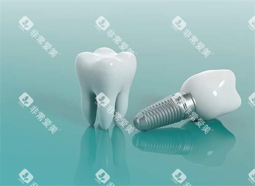 种植牙模具示意图 种植牙模具示意图