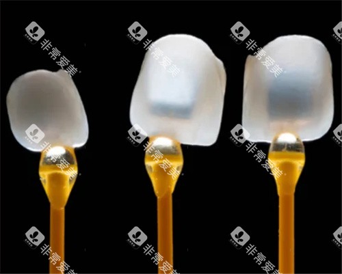 牙齿贴面透光性好 牙齿贴面透光性好