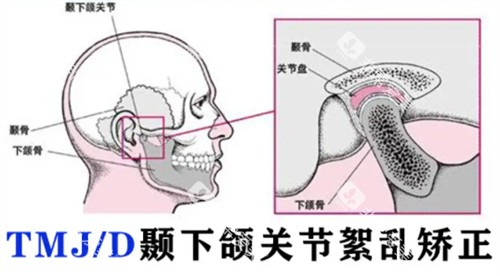 颞下颌关节紊乱矫正 颞下颌关节紊乱矫正