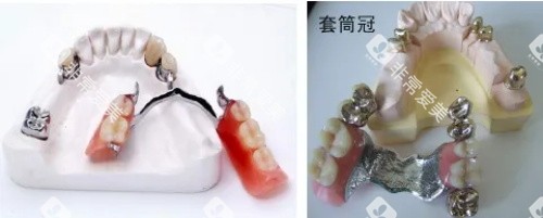 无挂钩假牙展示图 无挂钩假牙展示图