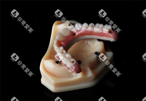 peek支架半口假牙 peek支架半口假牙