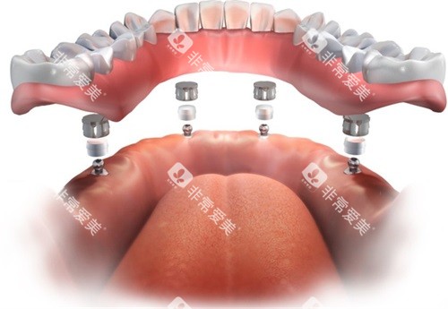 半口种植牙牙冠安装示意图 半口种植牙牙冠安装示意图
