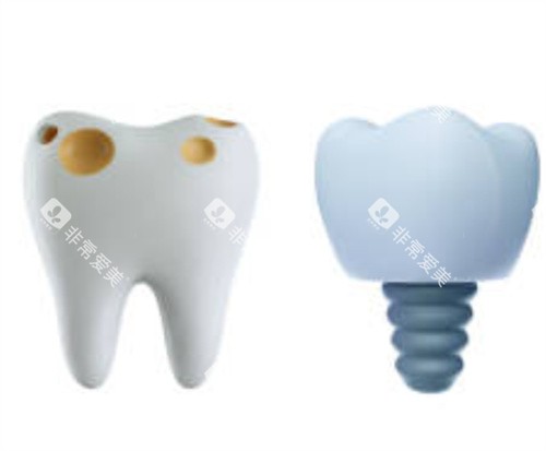 坏的牙齿和种植牙 坏的牙齿和种植牙