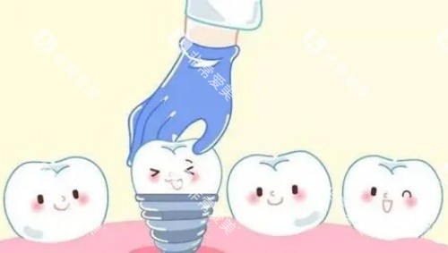 单颗牙齿种植示意图