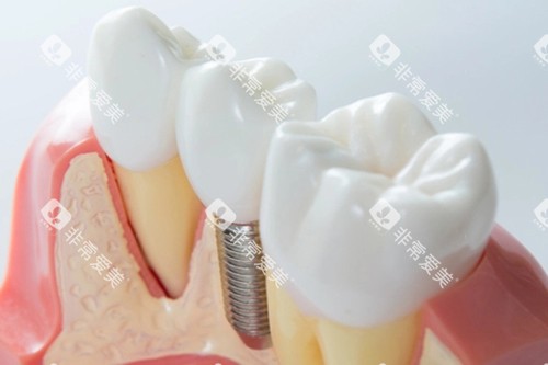 单颗种植牙模型示意图 单颗种植牙模型示意图