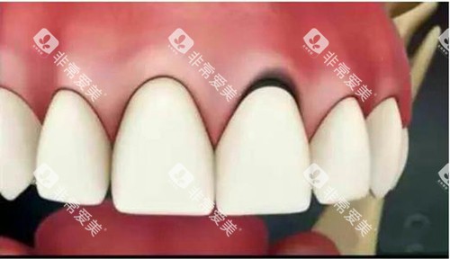 烤瓷牙基牙黑线