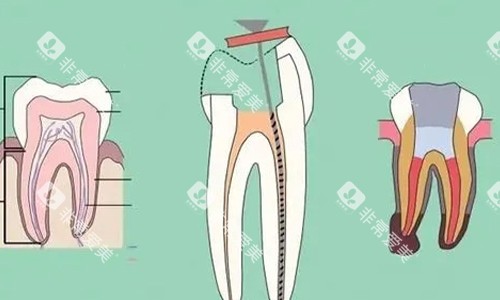 根管治疗的步骤示意 根管治疗的步骤示意