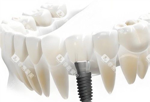 种植牙卡通展示展示图