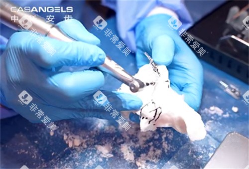 中科安齿种植牙操作过程