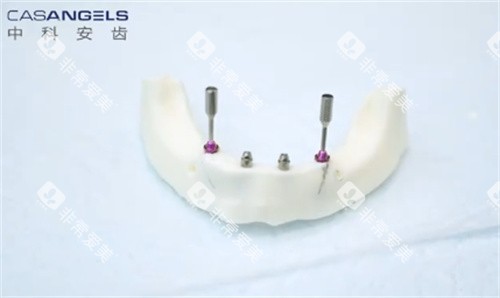 中科安齿种植牙
