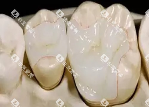 嵌体补牙 嵌体补牙