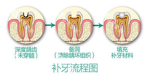 补牙流程 补牙流程