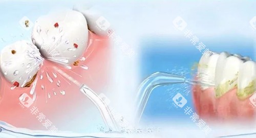 洗牙卡通示意图 洗牙卡通示意图