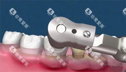 抛光洗牙 抛光洗牙