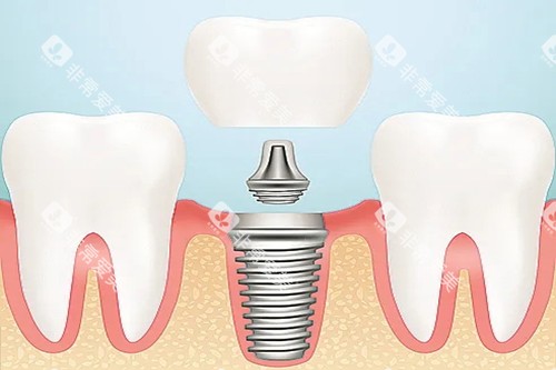 口腔种植牙卡通示意图 口腔种植牙卡通示意图