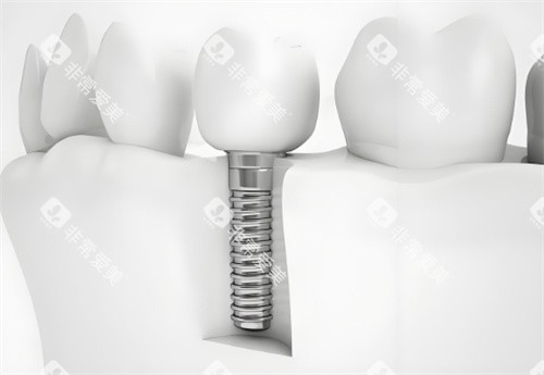 种植牙模型图片