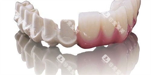 peek支架内部结构展示 peek支架内部结构展示