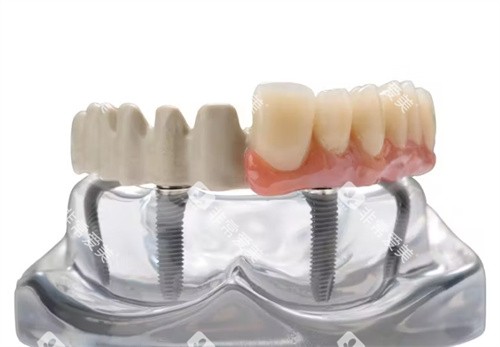 peek支架半口修复义齿 peek支架半口修复义齿