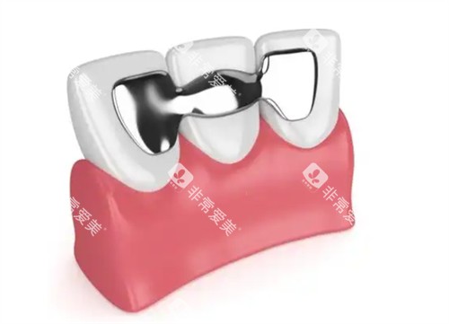 马里兰桥是什么 马里兰桥是什么