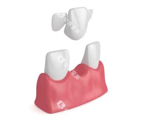 马里兰桥安装 马里兰桥安装