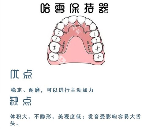 牙齿矫正哈雷保持器