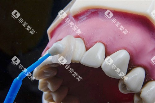 粘贴贴面 粘贴贴面