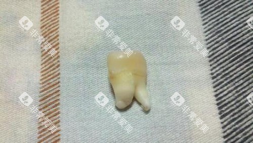 智齿实物展示图 智齿实物展示图