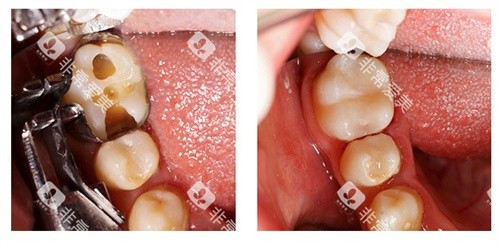 树脂补牙前后 树脂补牙前后