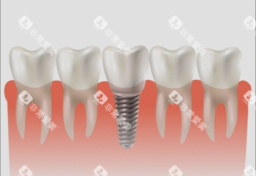 种植牙单颗漫画示意图 种植牙单颗漫画示意图