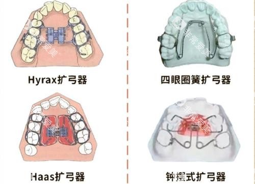 扩弓器的种类