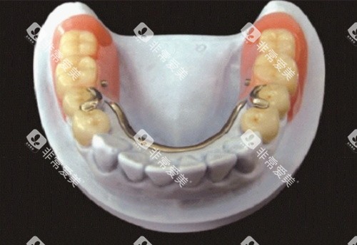 无挂钩假牙半口展示 无挂钩假牙半口展示