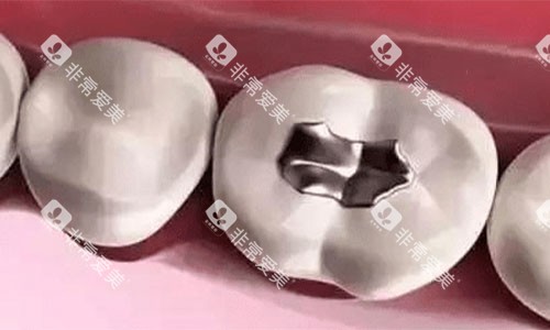 银汞合金的补牙术后 银汞合金的补牙术后
