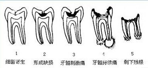 龋齿一度到五度图片