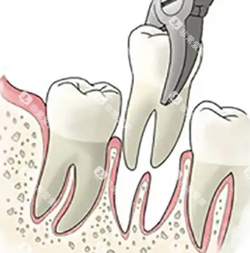 拔牙动画图片 拔牙动画图片