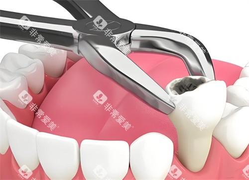 拔牙动画展示图 拔牙动画展示图