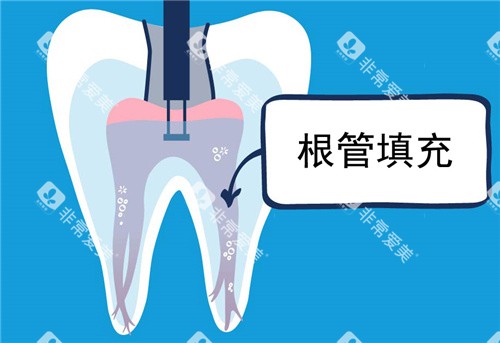 根管填充图示 根管填充图示