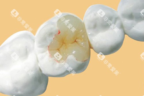 补牙示意图 补牙示意图