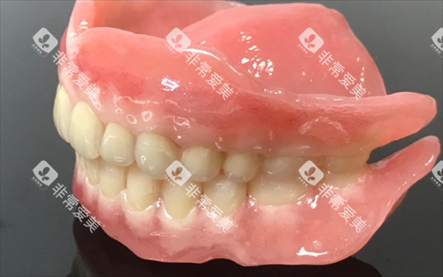 吸附式假牙全口模型展示