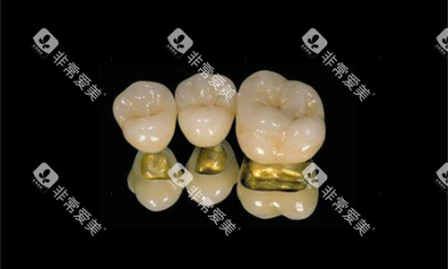 各类金属烤瓷牙展示图