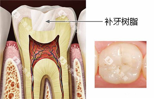 补牙树脂结果图 补牙树脂结果图