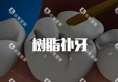 树脂补牙卡通 树脂补牙卡通