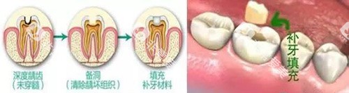 补牙过程展示 补牙过程展示
