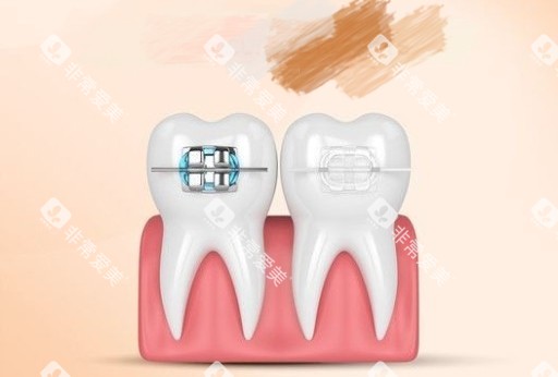 牙齿矫正金属和陶瓷托槽漫画图 牙齿矫正金属和陶瓷托槽漫画图