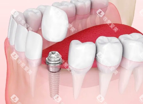 种植牙清晰展示