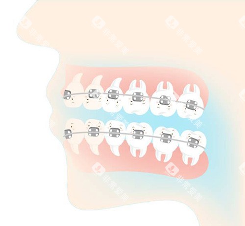 牙齿矫正侧面动画 牙齿矫正侧面动画