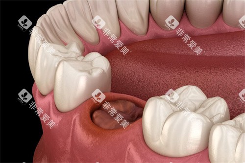 拔牙后牙窝 拔牙后牙窝