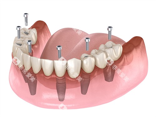 半口种植牙植体图 半口种植牙植体图