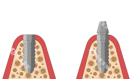 种植牙桩体展示 种植牙桩体展示
